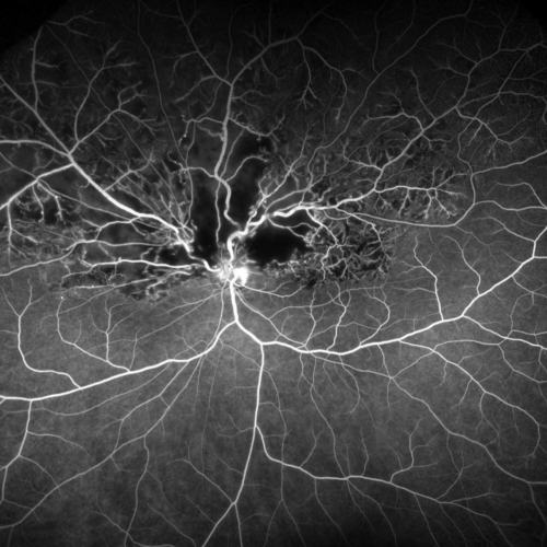 OPTOS Ultra Widefield Imaging Northern Sydney Cataract