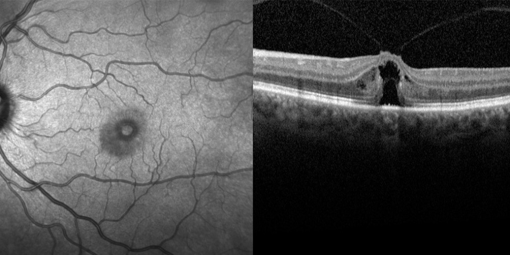 LEFT-MACULA-HOLE