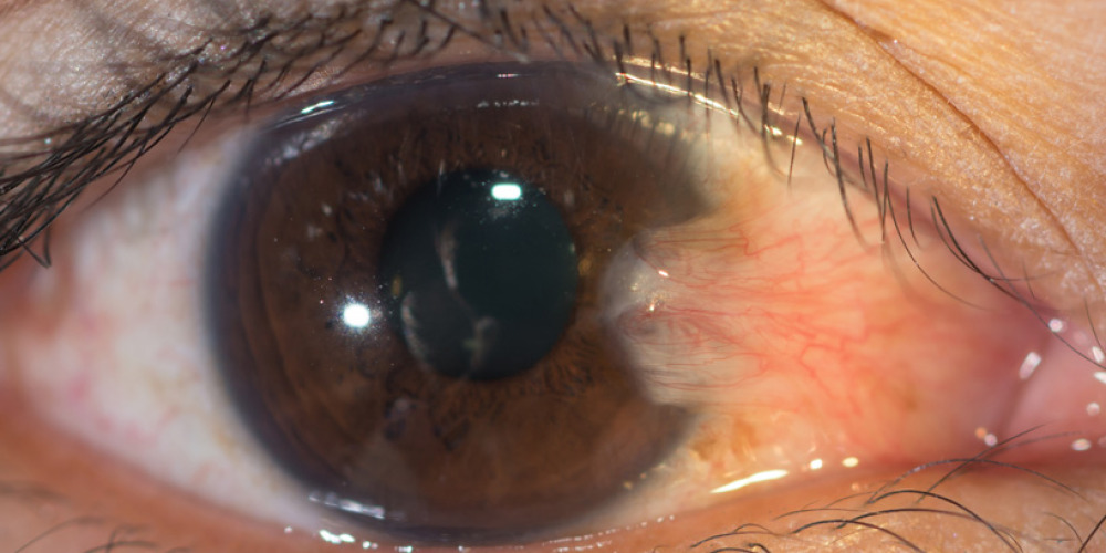 Pterygium