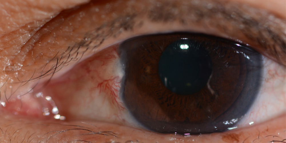 Pterygium2