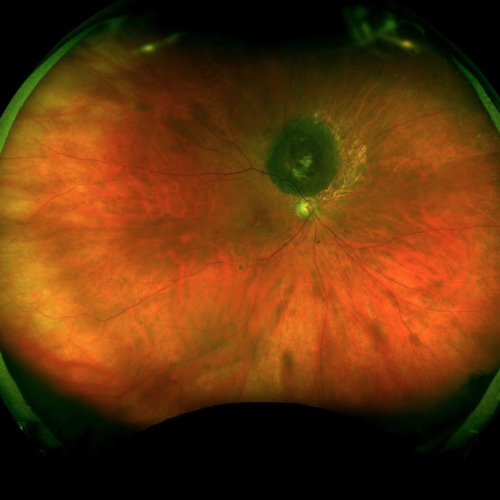 Optos Ultra-widefield Imaging - Northern Sydney Cataract