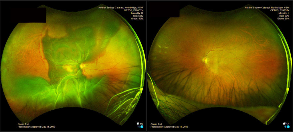 OPTOS Ultra-widefield Imaging - Northern Sydney Cataract